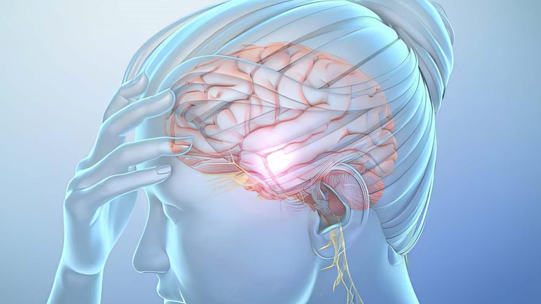 What is a Migraine.jpg