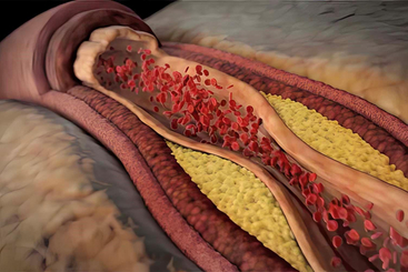 High Blood Pressure.jpg