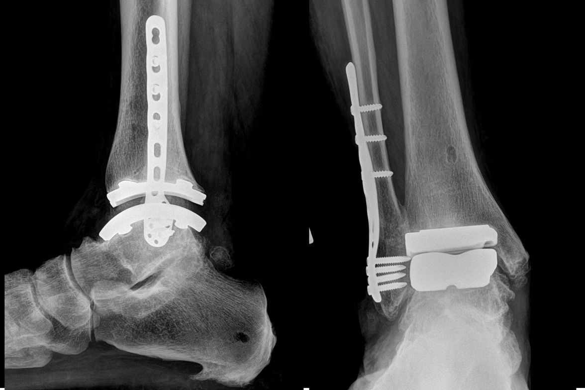 ankle replacement xray.png